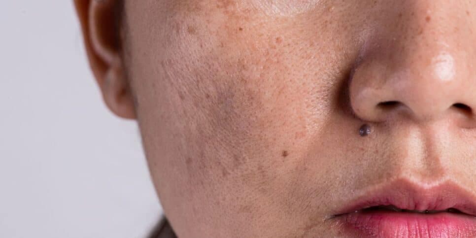Ilustração melasma (Foto: Canva) Ilustração melasma (Foto: Canva)