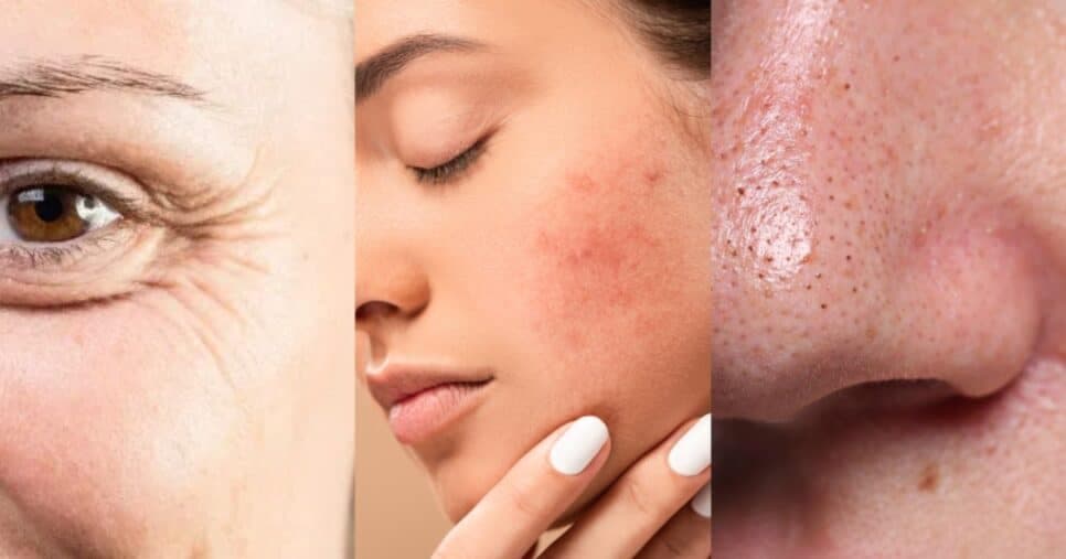 Fim das rugas, manchas e cravos: Detox facial com 4 ingredientes traz pele de seda enquanto idosas 60+ dormem