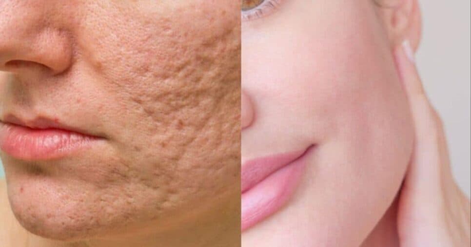 Pele lisinha para sempre: Receita com 4 ingredientes preenche poros abertos e remove manchas das mulheres 18+