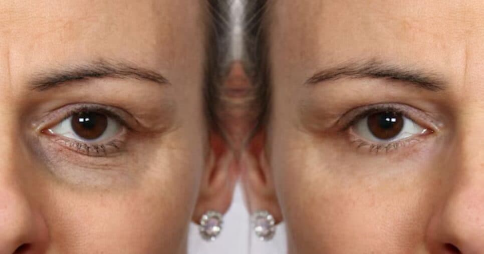 Antes e depois de olheiras (Footo: Freepik)