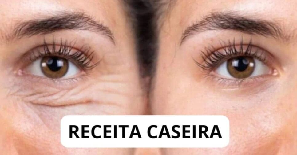 Descobri como dar adeus às rugas sem plástica com esse botox caseiro