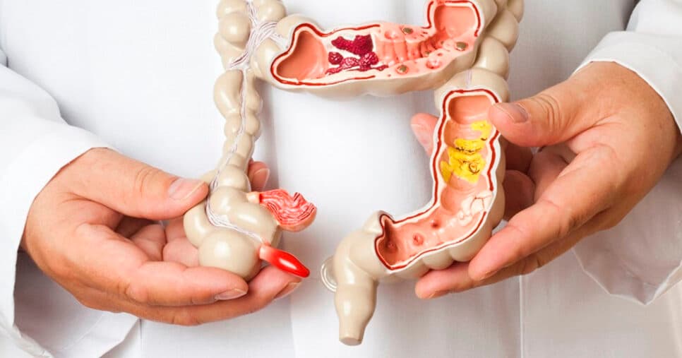 Sintomas de câncer no intestino (Foto: Reprodução) Sintomas de câncer no intestino (Foto: Reprodução)