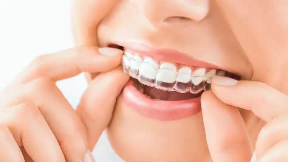 Tratamento com Invisalign (Foto: Reprodução/ Internet)