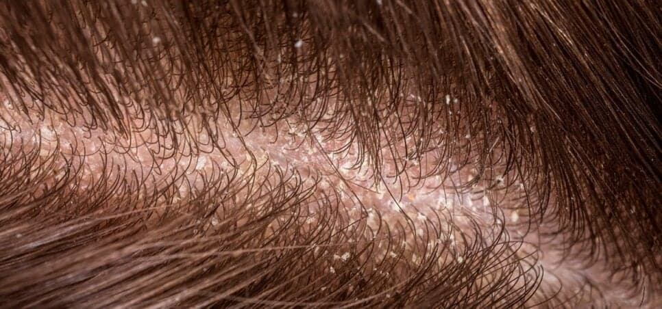 Cabelo com caspas (Foto: Divulgação)
