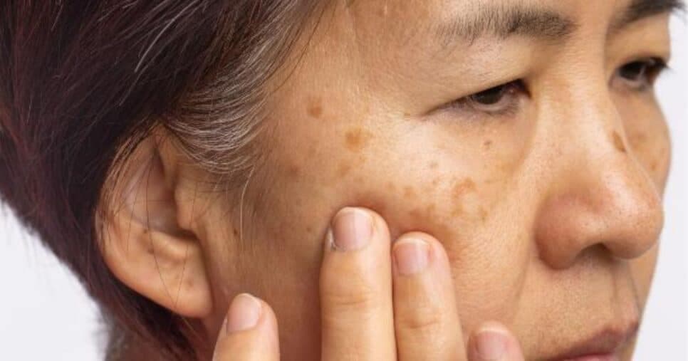 Truque caseiro com camomila: Como preparar a água que ajuda a clarear manchas