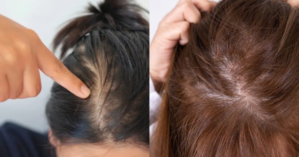 Dermatologistas revelam: O erro que faz seu cabelo parecer mais fino