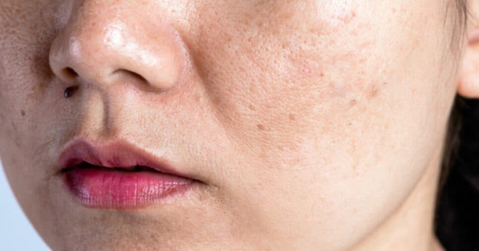 Misturinha com 3 ingredientes traz botox natural e fim das rugas e manchas na pele das mulheres