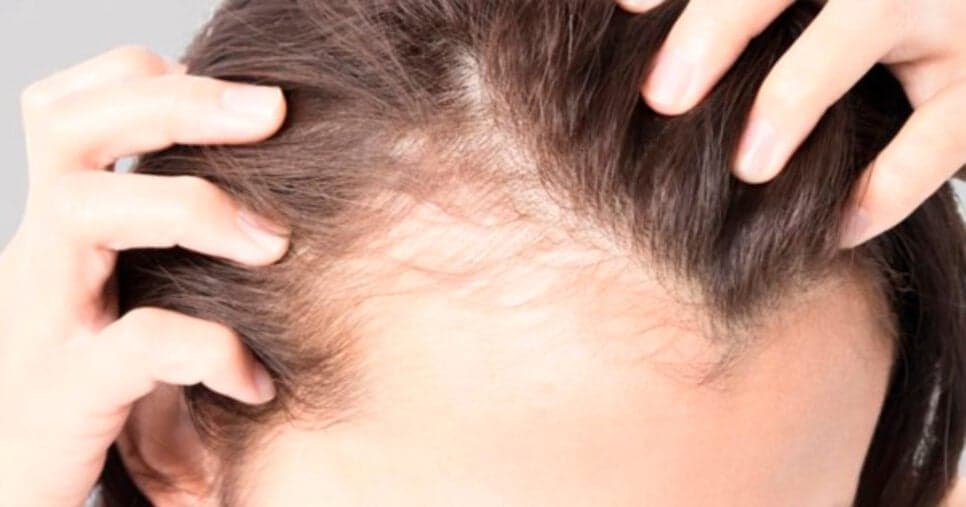 Adeus, entradas: 5 cortes de cabelo que disfarçam a calvície das mulheres