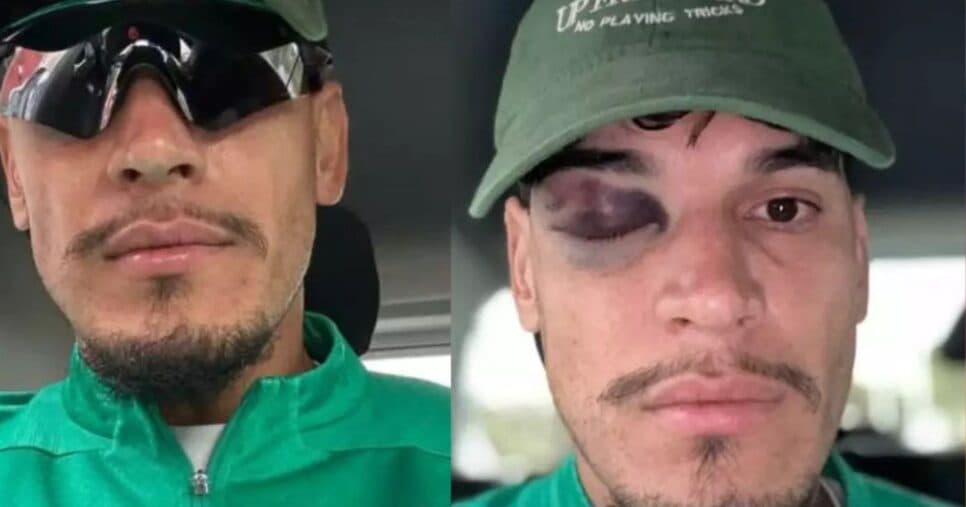 Gustavo Gómez posta foto com olho roxo - Foto: Instagram