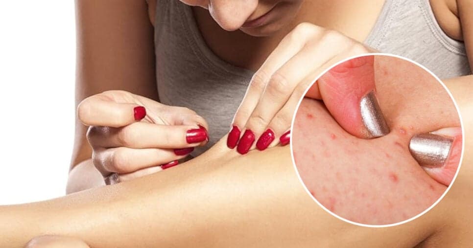Aproveite o Verão sem bolinhas: 4 dicas que acabam com pelos encravados sem gastar nada