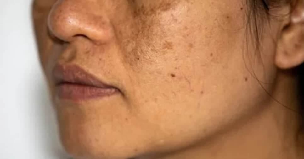 Fim do melasma: Creme acaba com manchas e turbina a hidratação da pele por R$69