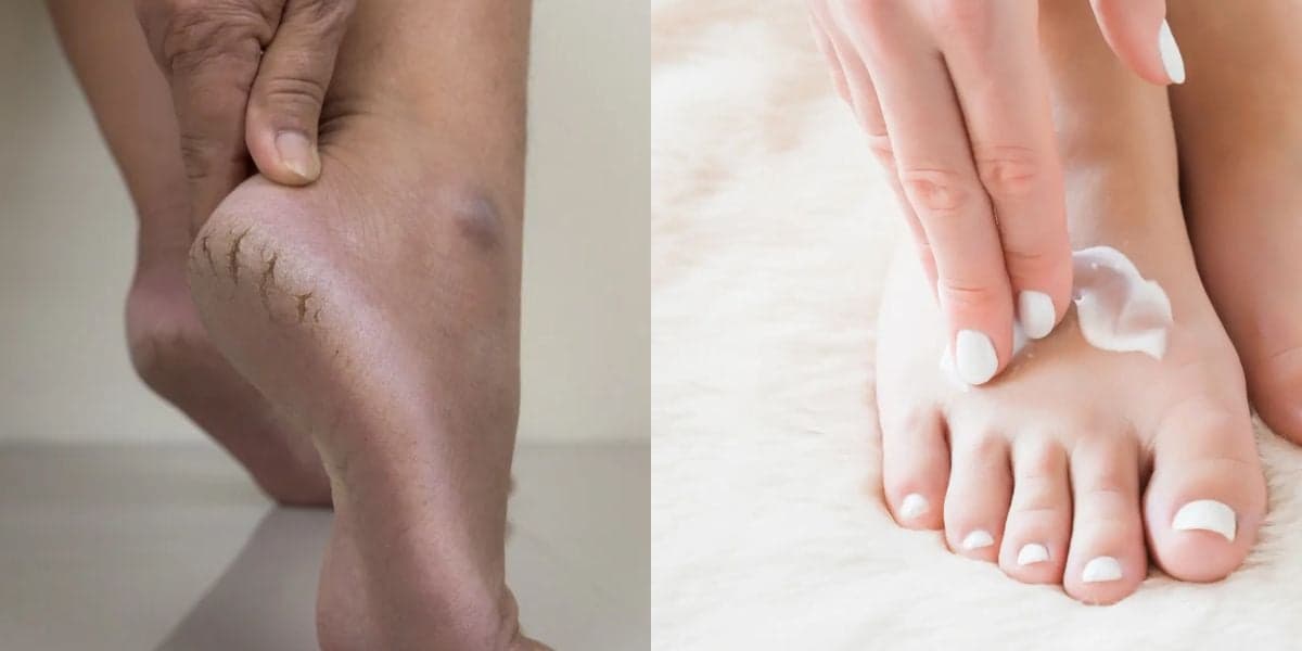 Trate a rachadura dos pés: Como fazer hidratante caseiro para repor nutrientes da pele