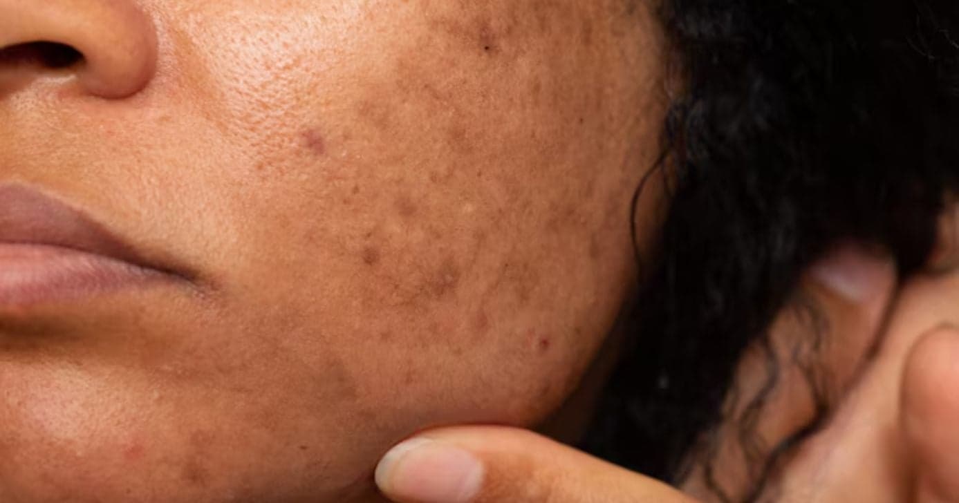 Melasma no rosto: 7 erros que pioram as manchas escuras e como evitá-los