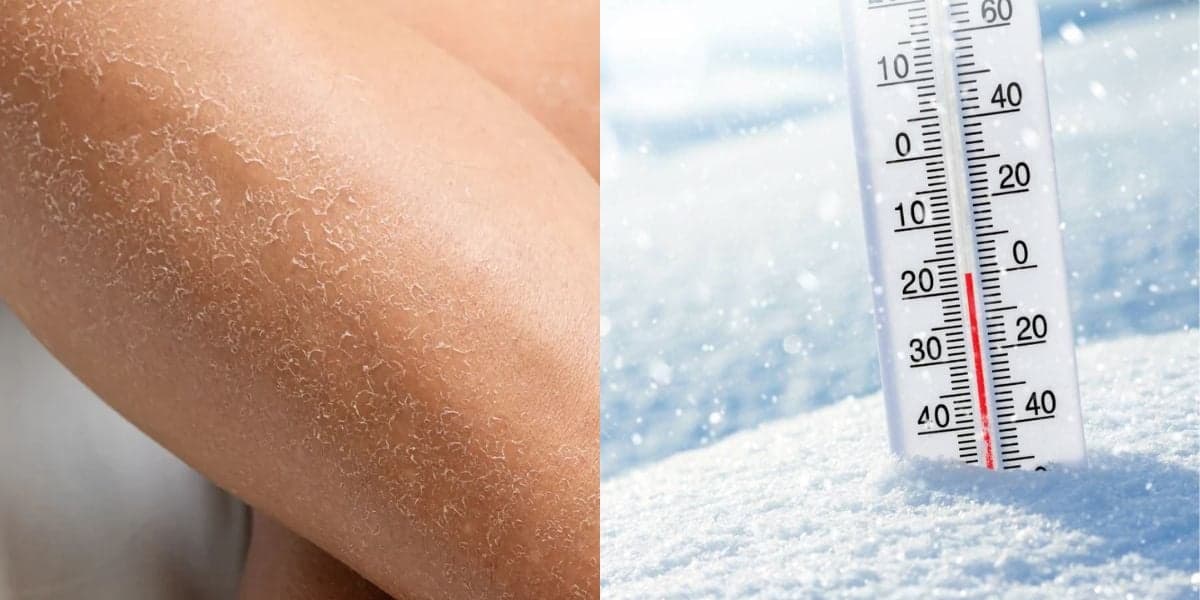 5 passos para evitar que o vento frio deixe a sua pele irritada e descamando