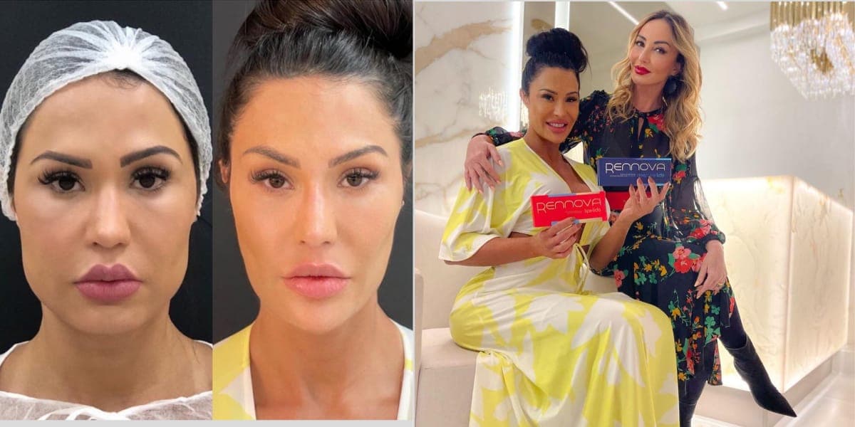 Gracyanne Barbosa explica as mudanças que fez em seu rosto e mostra a diferença do antes e depois (Reprodução: Instagram) Gracyanne Barbosa explica as mudanças que fez em seu rosto e mostra a diferença do antes e depois (Reprodução: Instagram)