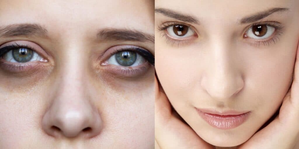 Pessoa com olheiras / Pessoa sem olheiras - Montagem TVFOCO Pessoa com olheiras / Pessoa sem olheiras - Montagem TVFOCO