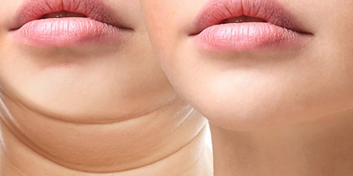Mulher com papada / Mulher sem papada - Montagem TVFOCO Mulher com papada / Mulher sem papada - Montagem TVFOCO