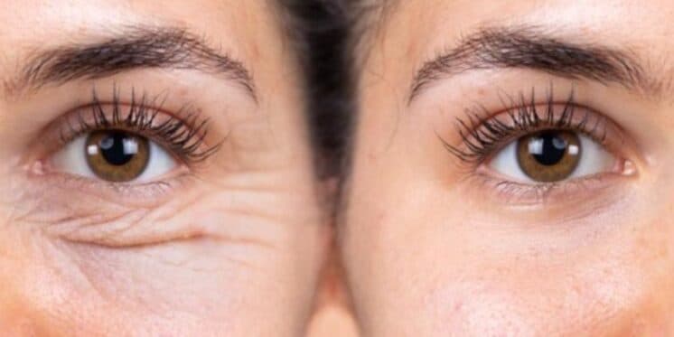 Olhos caídos / Olhos sem olheiras - Montagem TVFOCO Olhos caídos / Olhos sem olheiras - Montagem TVFOCO