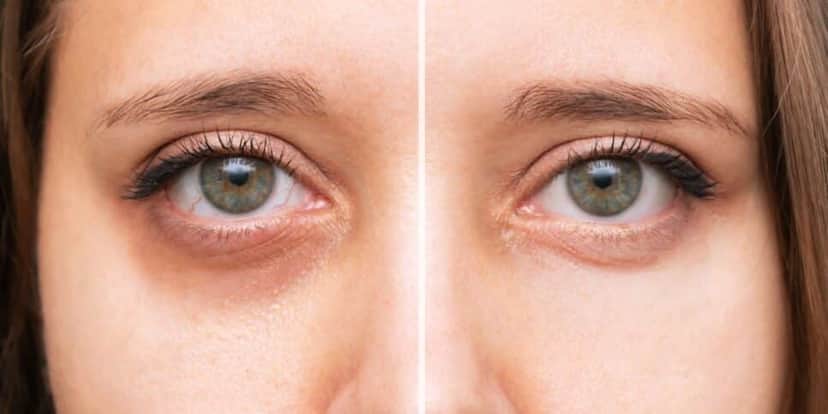 Mulher com olheiras e sem (Foto: Reprodução / Canva) Mulher com olheiras e sem (Foto: Reprodução / Canva)