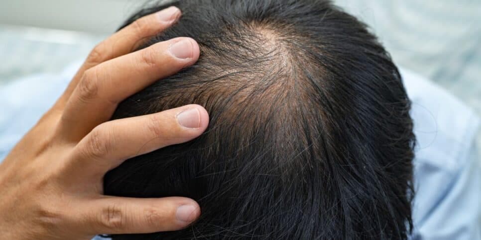 Calvície - Queda de cabelo (Foto: Reprodução) Calvície - Queda de cabelo (Foto: Reprodução)