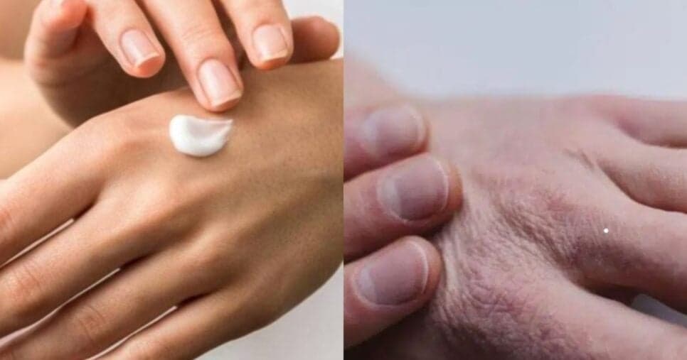 Eternamente jovem: Creme caseiro com 3 ingredientes traz fim das mãos enrugadas e com manchas