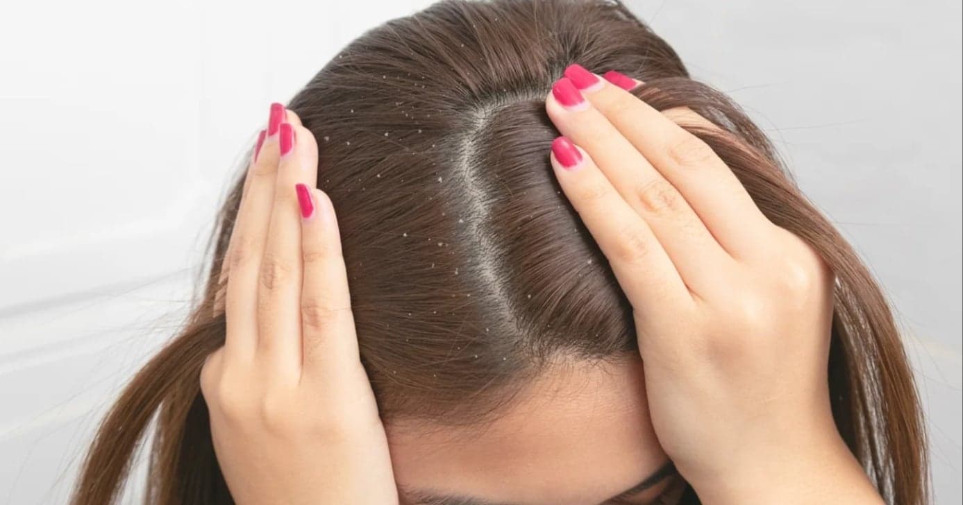 Como acabar com a caspa em casa usando óleo essencial no shampoo
